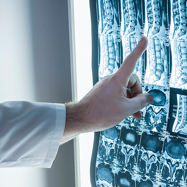 Tomografia computerizată (CT) a coloanei vertebrale